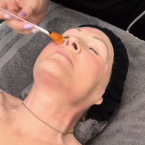 non surgical facelift in Houston TX